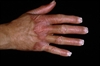 Acral erythema