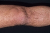 Anterior cruciate ligament rupture