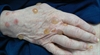 Multiple blisters on the hands and abdomen Home surgery leads to persistent neck mass