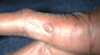 Growth on the fingers