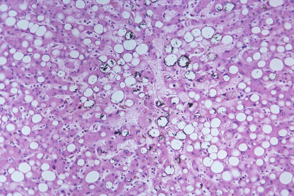Nonalcoholic steatohepatitis (NASH)
