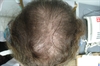 Thinning hair at the frontal scalp and crown Painful shin lesions described as bumps
