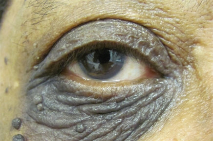 Discoloration Of The Eyelid - The Clinical Advisor