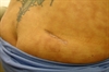 Derm Dx: Reticulated erythema on the lumbar back