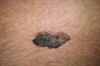 Newly developed brown papules Spreading macules Hardened plaque