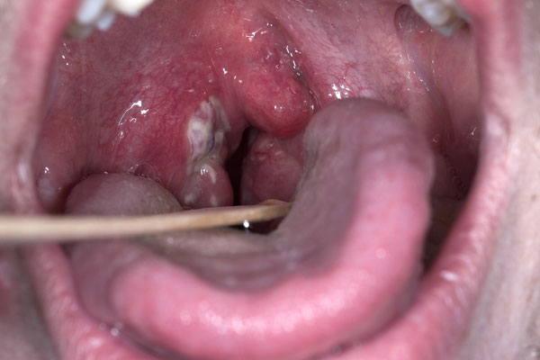 White Patches Throat