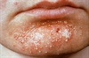Chemotherapy-Related Skin Toxicities