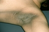 Diabetes: Cutaneous Manifestations