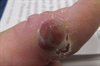 Yellow papules Swollen chest nodule Bleeding blister
