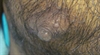 Yellow papules near the nipple