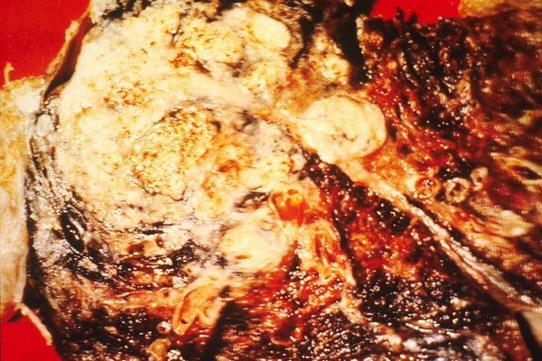 Lung Cancer