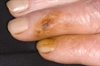 Brown stain on the fingers and fingernails of a cigarette smoker due to tar and nicotine build up from tobacco.