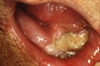 Smoking and other tobacco use are associated with 70% to 80% of oral cancer cases. The most common symptoms include a sore patch on the tongue, lips, gums, or other area inside the mouth that does not go away and may be painful.