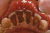 Yellow teeth are one of the most notorious effects of long-term smoking, but smokers also develop gum disease, persistent bad breath, plaque and tartar buildup and are twice as likely to loose teeth as nonsmokers.