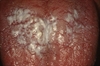 Stomatitis, or oral inflammation, is caused by repeatedly inhaling heated smoke from cigarettes or pipes. White lesions form on the hard palate of the mouth, and excess keratin produced by affected cells builds up on the tongue.