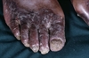 This patient, who lives in a resource-poor area of Africa and lacks access to medications, has an uncommon form of disseminated candidiasis. The majority of patients with HIV will develop one of three forms of mucocutaneous candidiasis: oropharyngeal, esophageal or vulvovaginal. Although easily treated with antifungal medications, candidiasis infections can interfere with medication administration and adequate nutrition intake.