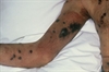 Kaposi sarcoma, a type of vascular cancer once only seen in elderly people of Jewish or Mediterranean descent, is one of the two most common opportunistic diseases associated with AIDS. Its spread, however, is an uncommon cause of death; AIDS patients are more likely to succumb to Pneumocystis carinii pneumonia, the other rampant opportunistic infection associated with AIDS.