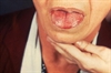 Oral hairy leukoplakia appears as white corrugated lesions on the tongue & is common among severely immunosupressed patients. Secondary infection with Epstein Barr Viru causes OHL. Lesions are usually asymptomatic but may cause altered taste or discomfort, and are sometimes confused with candidiasis. Specific treatment is generally not necessary, as lesions typically resolve with antiretroviral therapy. If the lesions are ulcerated or unusual, clinicians should biopsy to distinguish from cancer.