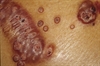 Molluscum contagiosum is a benign superficial skin disease caused by a poxvirus that occurs in children and adults worldwide. Although on average lesions are 2 mm to 5 mm in size, patients with HIV/AIDS can develop “giant” lesions that are ≥15 mm in diameter; larger numbers of lesions; and lesions that are more resistant to standard therapy.