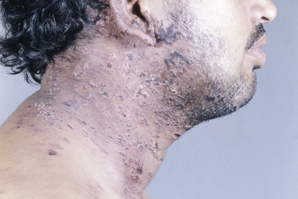 Hivaids Related Skin Conditions 4877