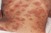 This patient has experienced weight loss due to muscle wastage associated with AIDS and has seborrheic dermatitis, marked by the darker patches on the skin.  Although seborrheic dermatitis occurs throughout the general population, it may be a clinical indication that full-blown AIDS has developed in patients who are HIV seropositive.
