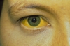 Identifying hepatitis infection