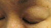 Yellow facial growths Vesicular eruption Depigmented area