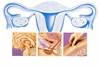 Menopause Symptoms & Complications Menopause Symptoms & Complications