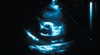 Preoperative ECHO does not improve survival in elective noncardiac surgery