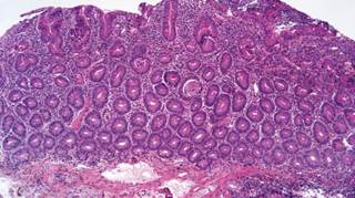 Photomicrograph showing complete atrophy of the duodenal villi. Photomicrograph showing complete atrophy of the duodenal villi.