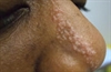 Linear pink papules Pink, pearly nasal papule Macular lip lesion