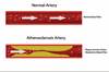 Hyperlipidemia & Coronary Heart Disease Hyperlipidemia & Coronary Heart Disease