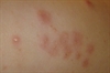 Diffuse erythematous papules