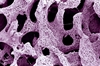 Osteoporosis Diagnosis, Prevention & Treatment