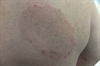 Clinical Challenge: Itchy pink patches