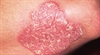 Growing skin plaques with scale
