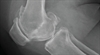 A new understanding of  osteoarthritis