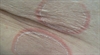 Trunk rashes with central clearing