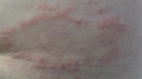 pinpoint rash on trunk