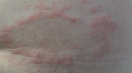 Rash 101: The Most Common Types of Skin Rashes