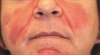 Bimalar facial rashes