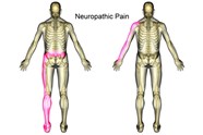 Neuropathic Pain Symptoms Treatment