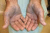 Clinical Challenge: Bluish-Black Skin Changes, Tendonitis And Arthritis