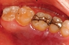 Case Report: Kaposi Sarcoma