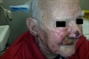 Clinical Challenge: Painful facial eruptions