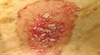 Asymptomatic red lesions