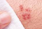 Shingles before 40 increases vascular risk Shingles before 40 increases vascular risk