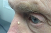 Clinical Challenge: White papule on the nose