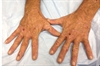 Derm Dx: A patient with erosions and reddish urine 