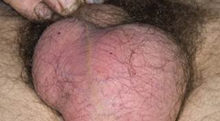Steroid skin syndrome